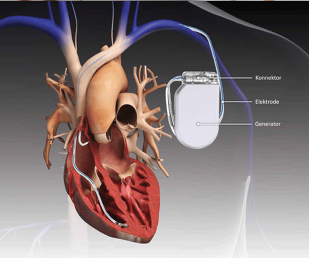 Pacemaker (ICD , CRT , CRT – D , CRT-P) – Heart Center Ranchi